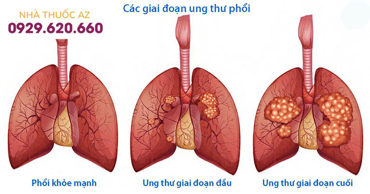 Ung thư phổi là bệnh lý thường gặp ở phổi nguy hiểm nhất