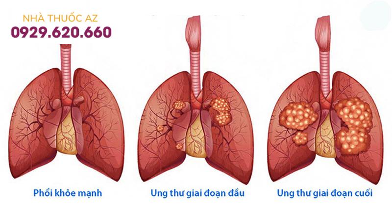 Các giai đoạn ung thư phổi ở người trẻ