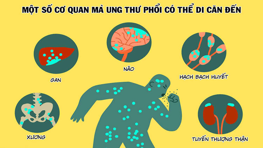 Có cách nào ngăn ung thư phổi di căn không?